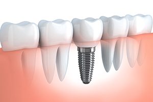 Dental Implant Cross Section