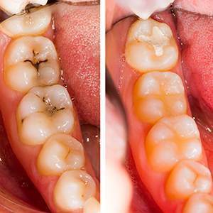 Before and After Dental Treatment