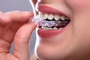 Woman with Invisalign