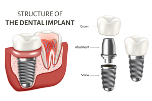 Structure of Dental Implants