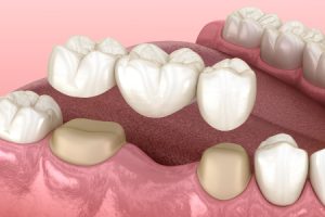 Dental Bridge Illustration