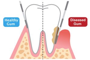 Periodontal Pockets