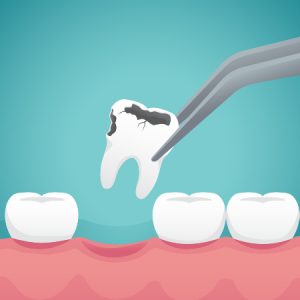 Tooth Extraction with Dry Socket