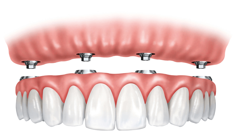 All-On-4 Implant Dentures