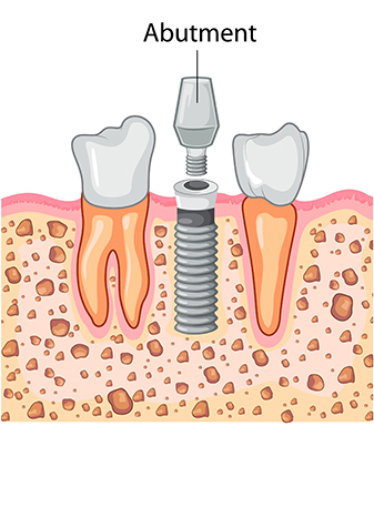 Dental Implant Process: Abutment