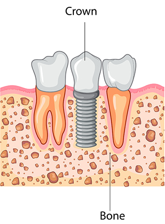 Dental Implant Process: Crown