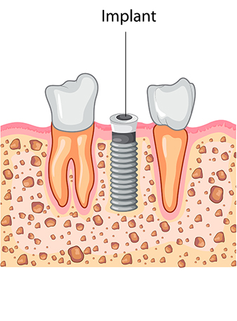 Dental Implant Process: Implant