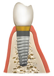 Final implant